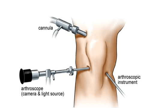 Arthroscopy Arthroscopy