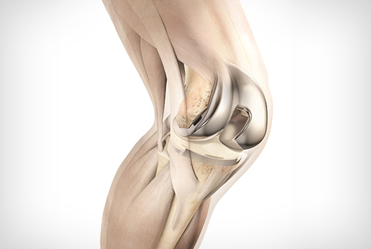 Joint Replacement Joint Replacement