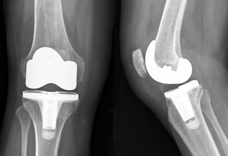 Knee Replacement Knee Replacement