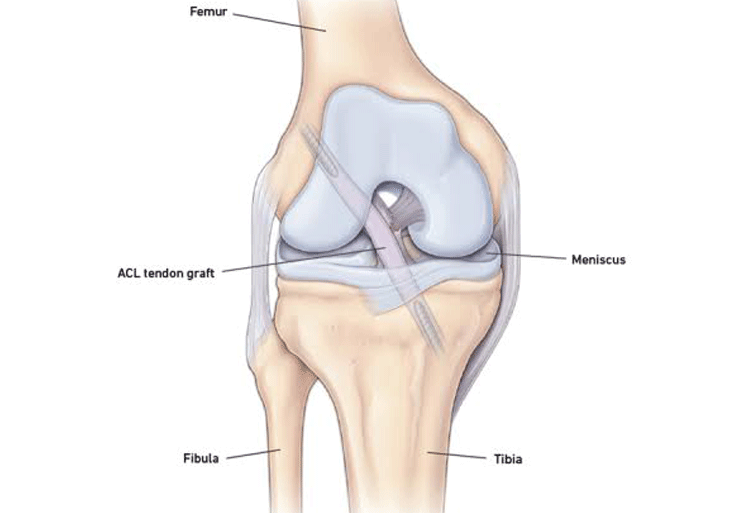Acl Reconstruction