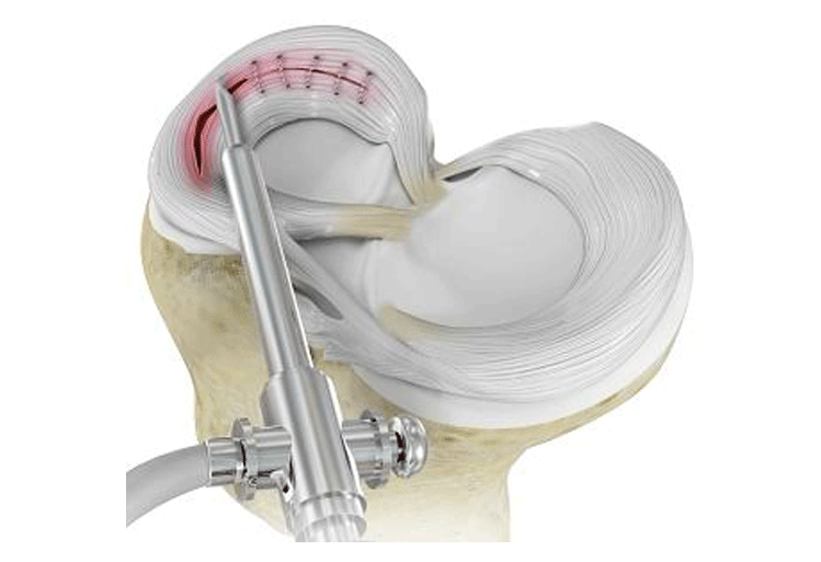 Meniscus Repair