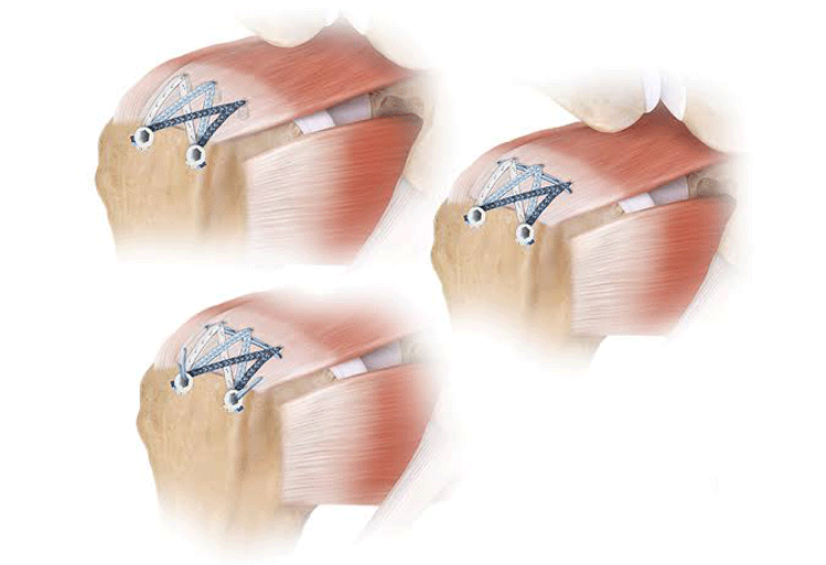 Rotator Cuff Repair Rotator Cuff Repair
