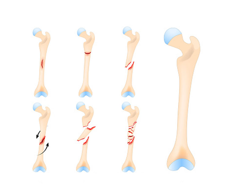 Bone Fracture Bone Fracture