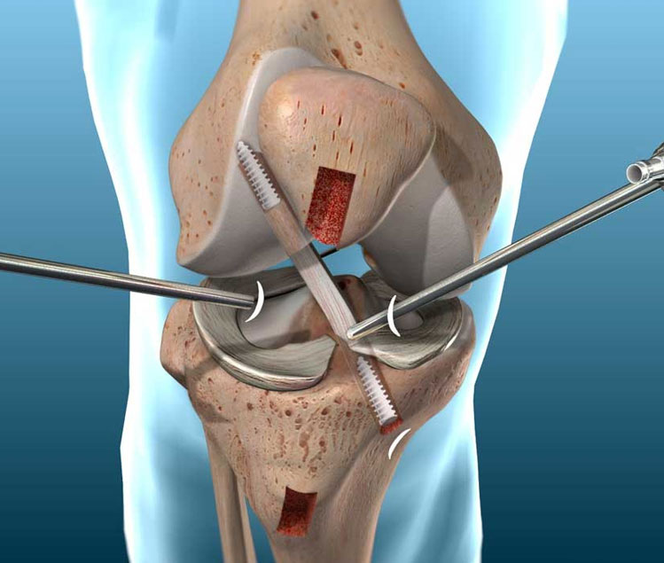 Acl Reconstruction