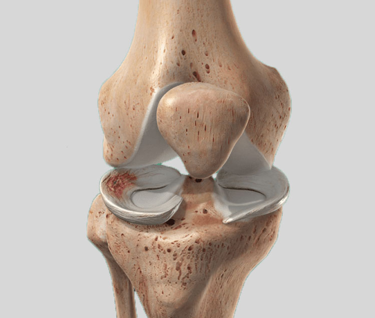 Meniscus Repair