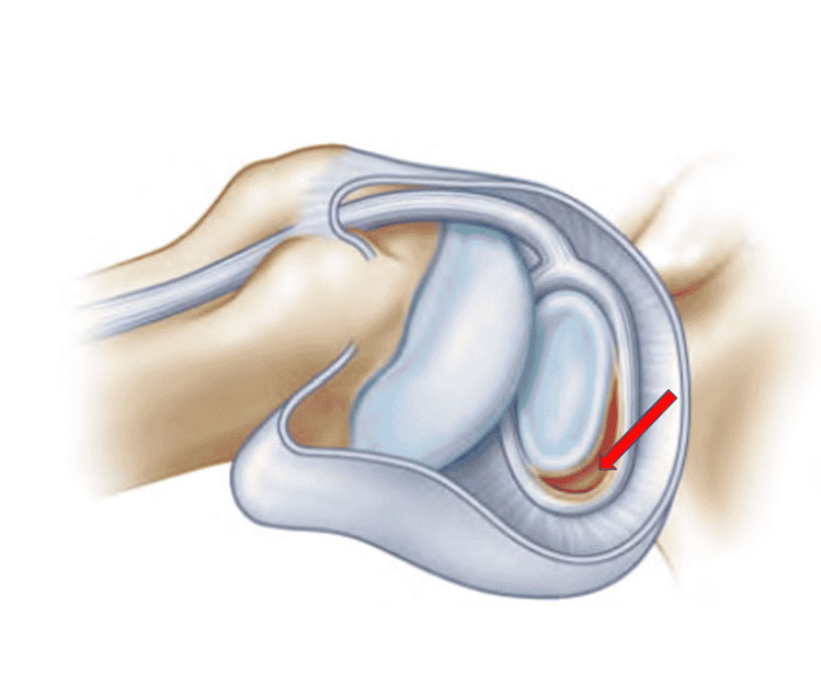 Shoulder Dislocation Shoulder Dislocation