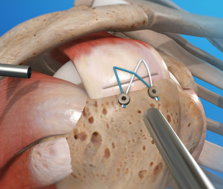 Rotator Cuff Repair Rotator Cuff Repair