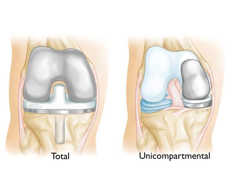 Partial Knee Replacement Partial Knee Replacement