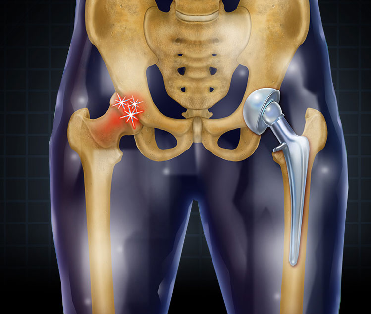 Hip Replacement Hip Replacement